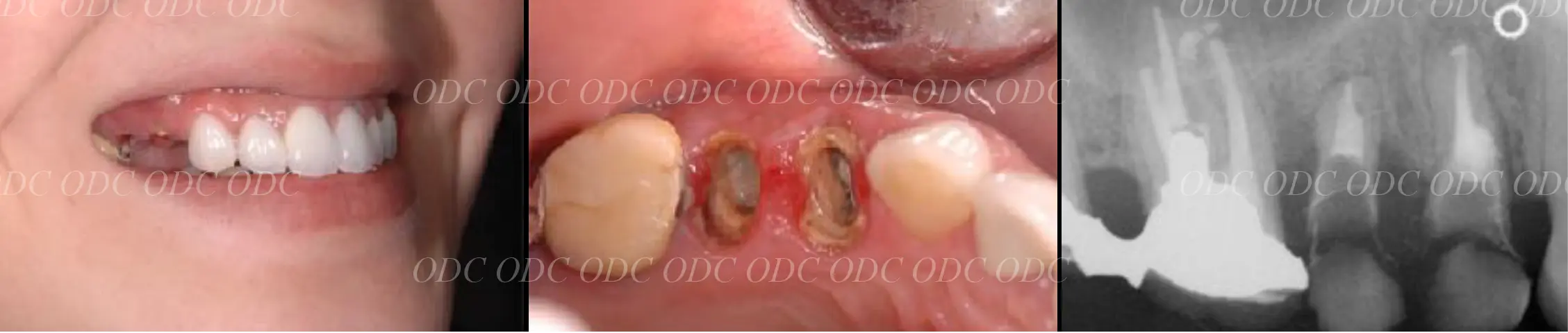 抜歯即時埋入症例