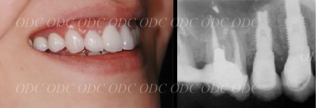 抜歯即時埋入症例