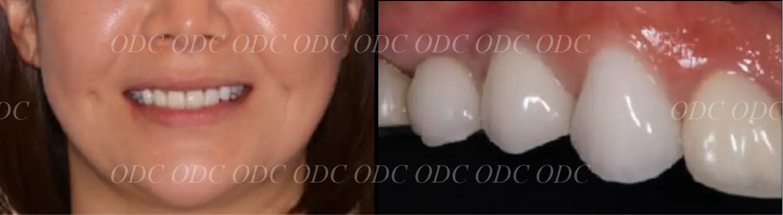 抜歯即時埋入症例