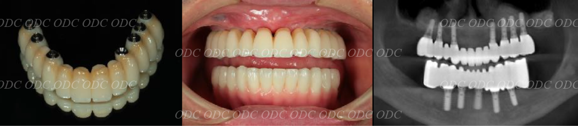 フルマウスリコンストラクション