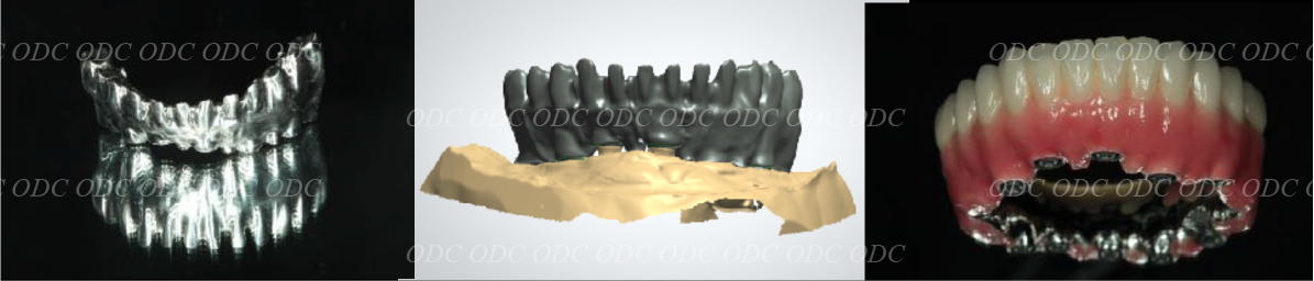 フルマウスリコンストラクション