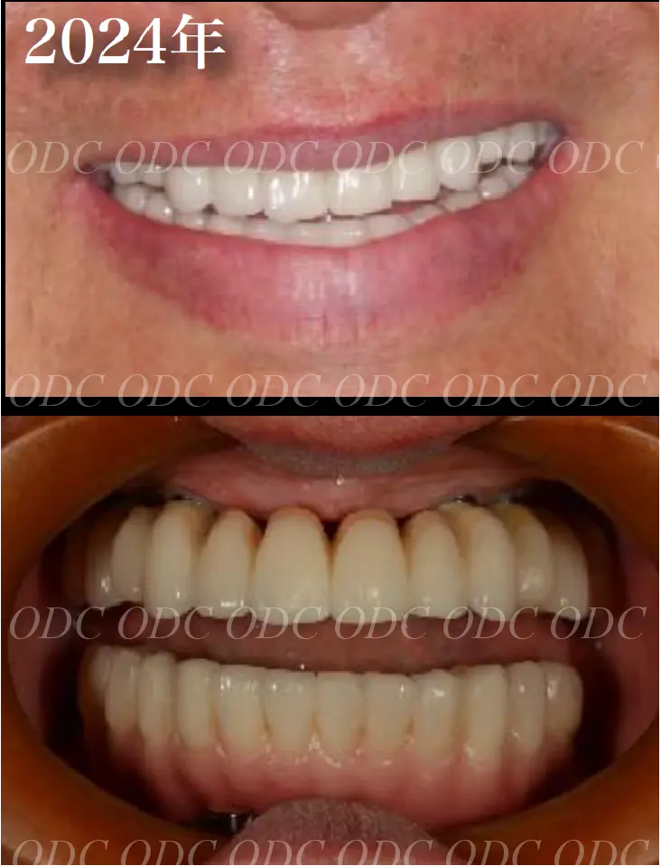 フルマウスリコンストラクション