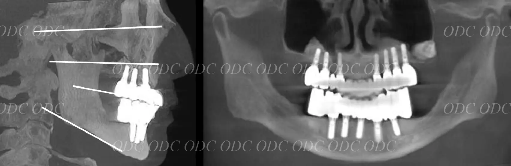 フルマウスリコンストラクション