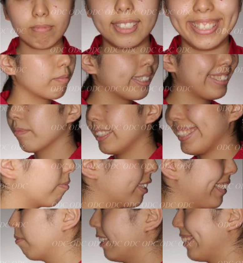 インプラント治療の流れ