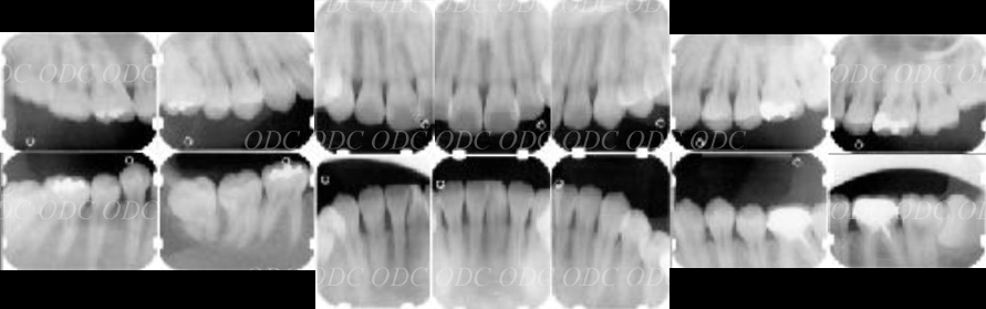 インプラント治療の流れ