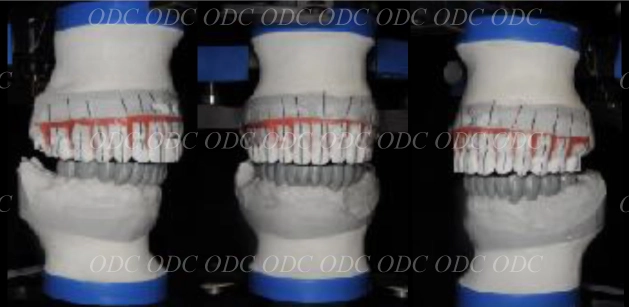 インプラント治療の流れ