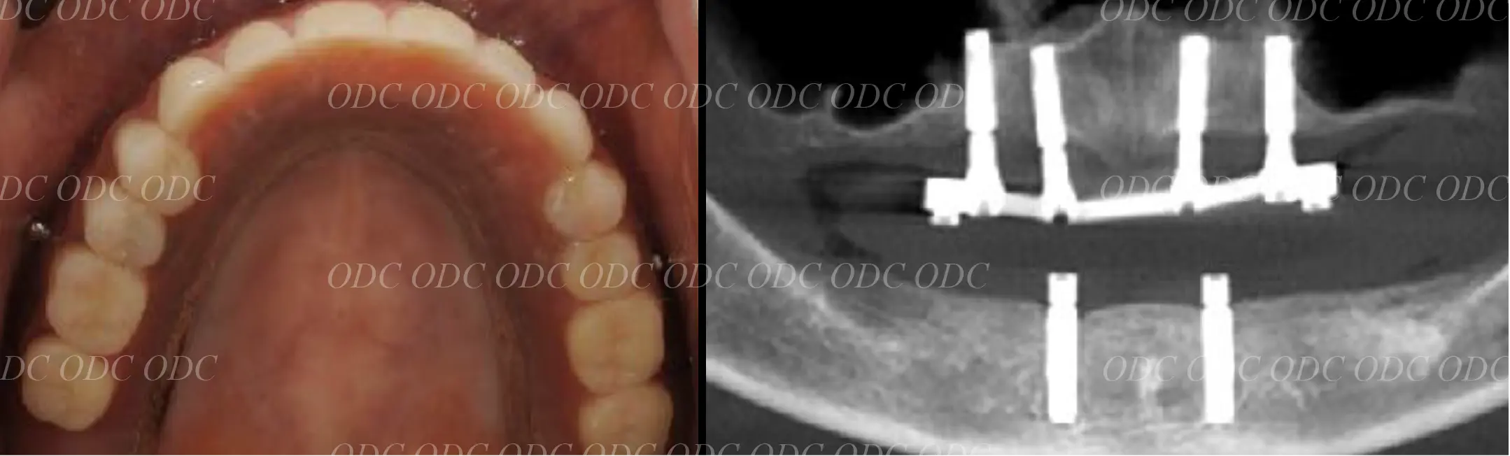 インプラントオーバーデンチャー