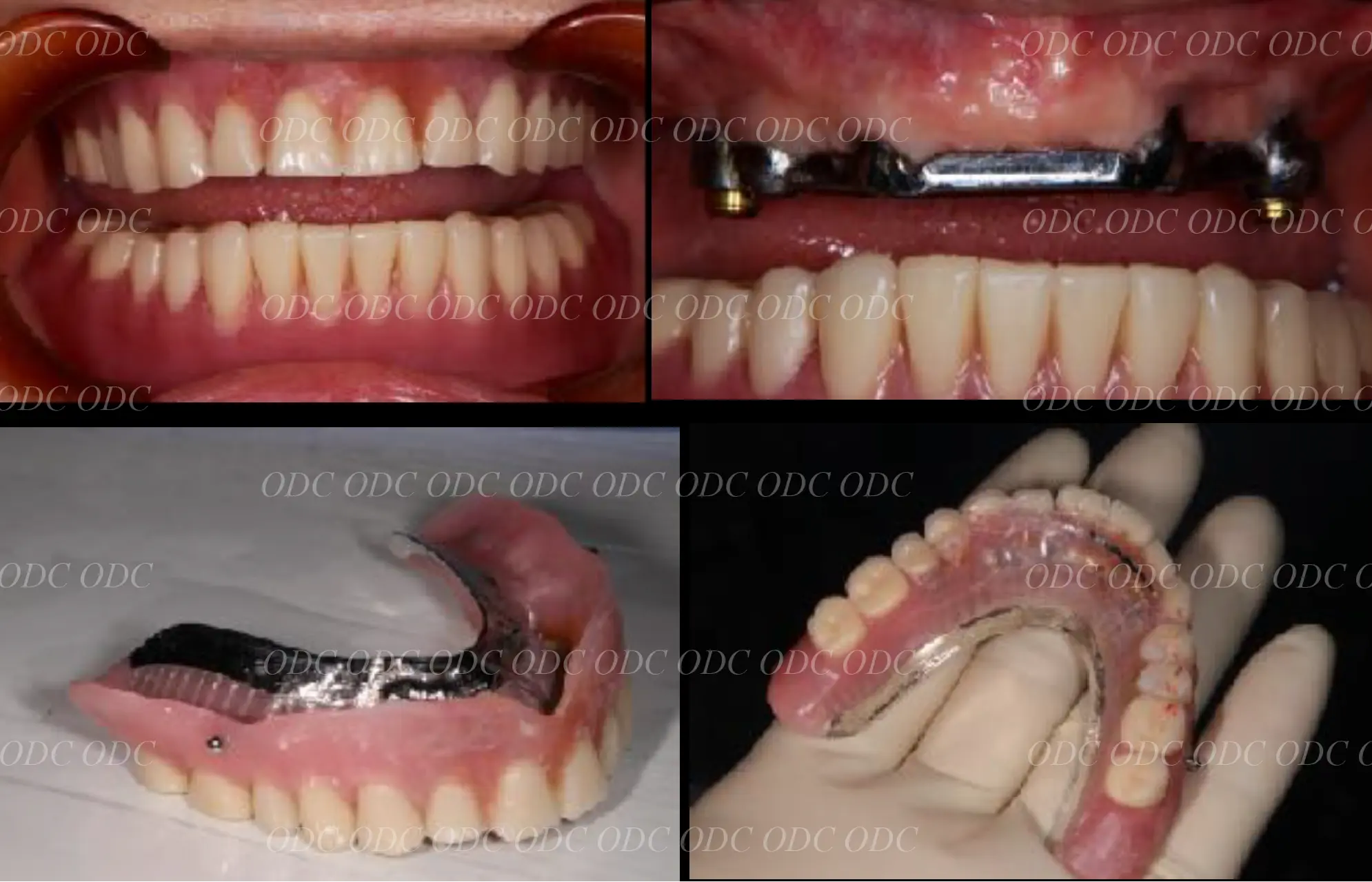 インプラントオーバーデンチャー
