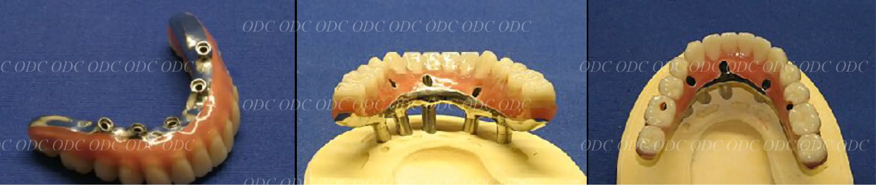 インプラント補綴（上部構造）