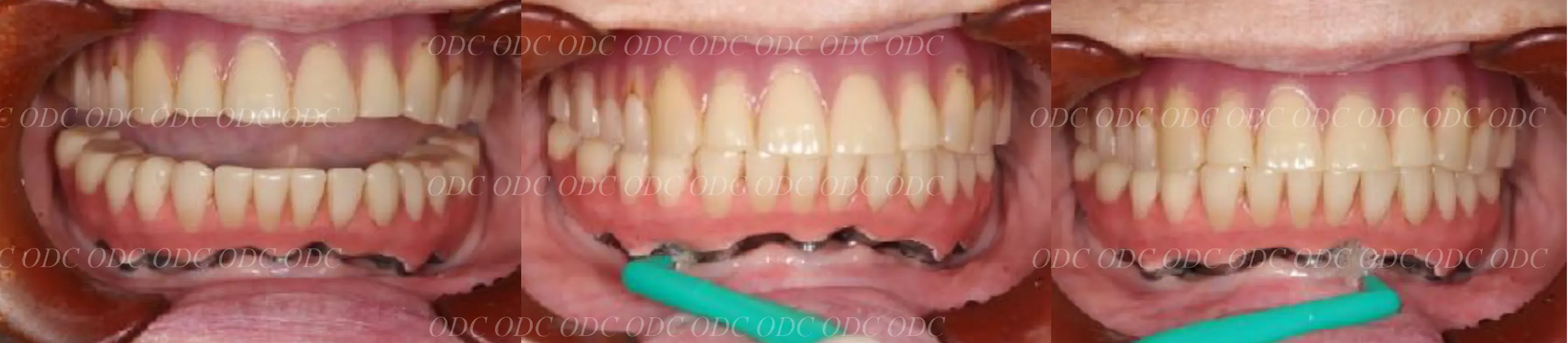 インプラント補綴（上部構造）