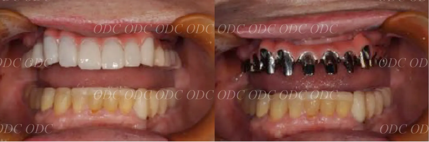 インプラント補綴（上部構造）