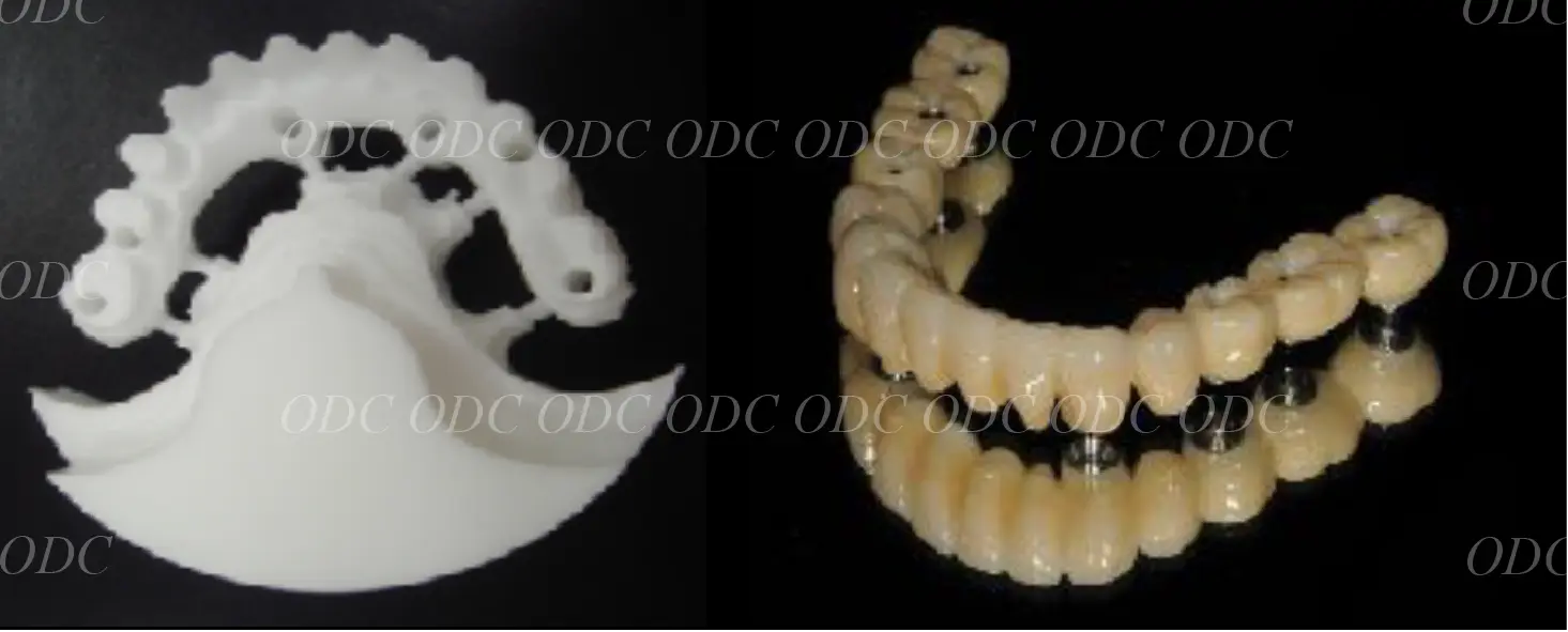 インプラント補綴（上部構造）