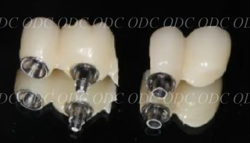 インプラント補綴（上部構造）