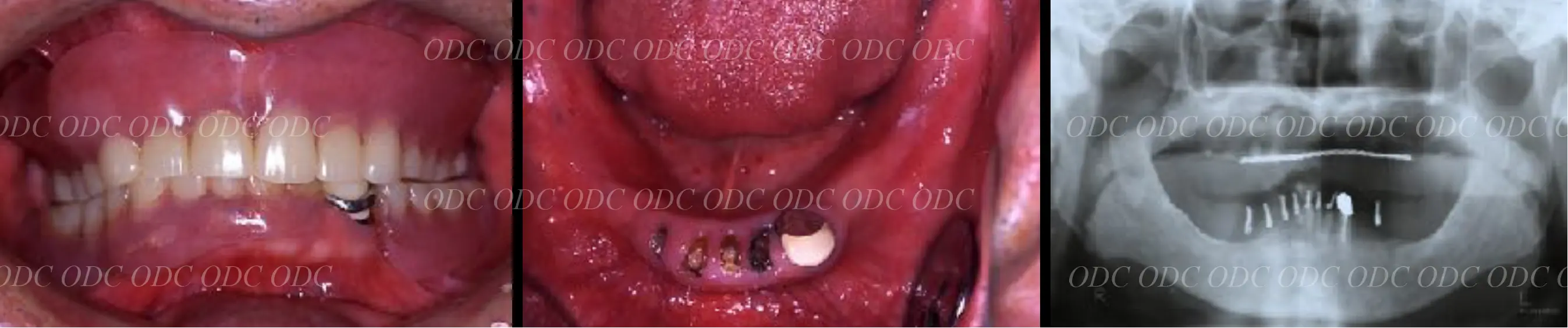 インプラント補綴(上部構造)