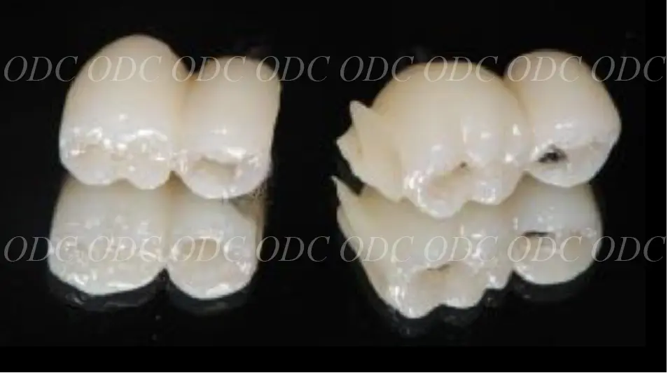 インプラント補綴（上部構造）