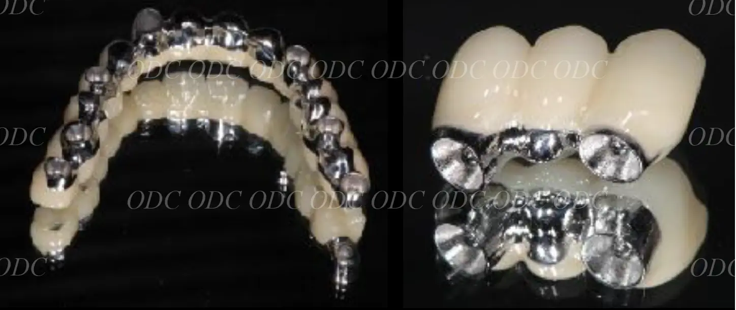 インプラント補綴（上部構造）