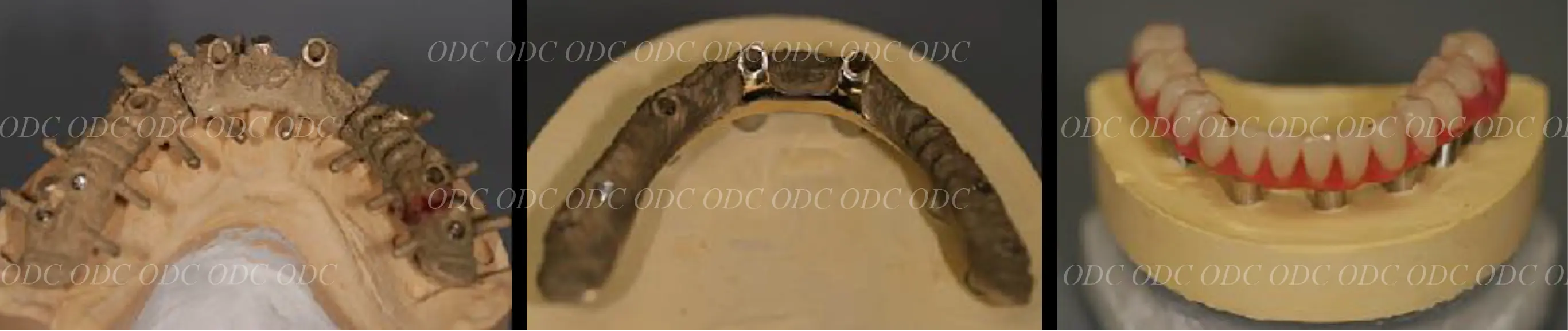 インプラント補綴(上部構造)