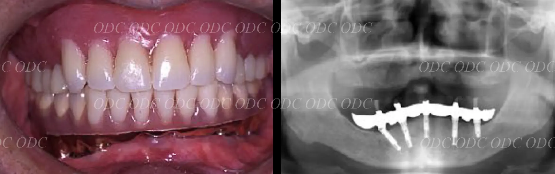 インプラント補綴(上部構造)