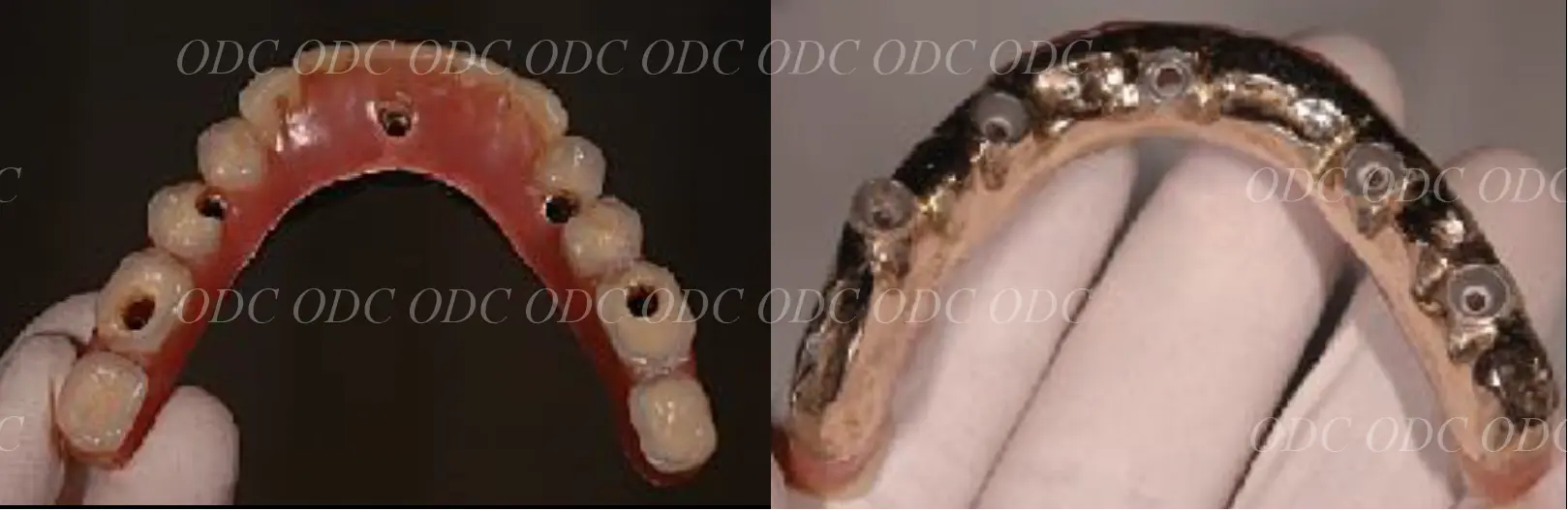 インプラント補綴（上部構造）