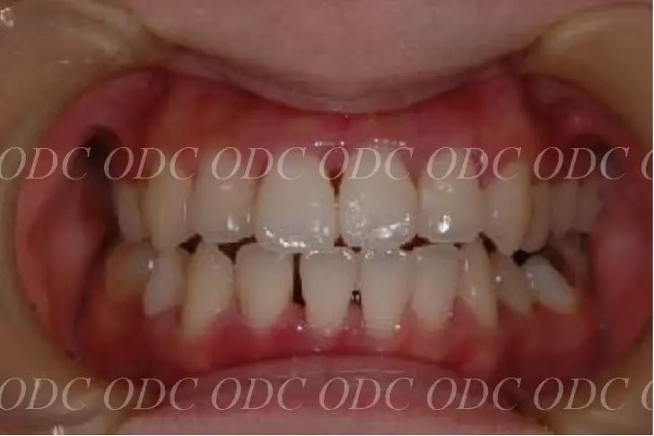 噛み合わせのズレ