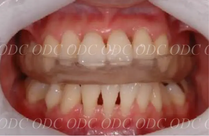 噛み合わせのズレ