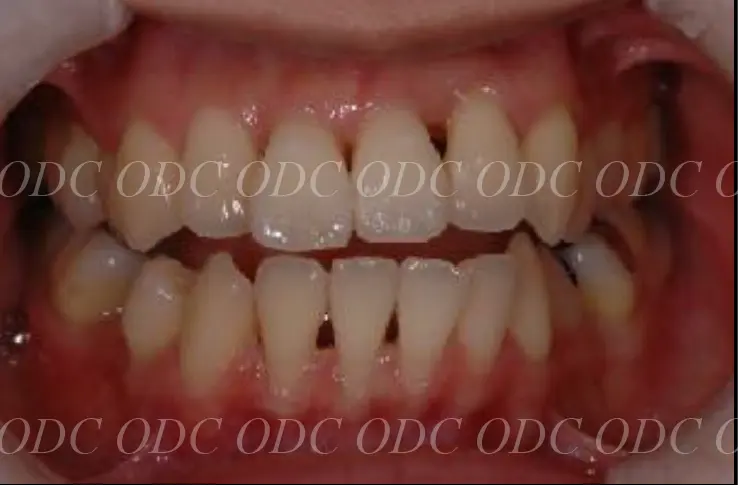 噛み合わせのズレ