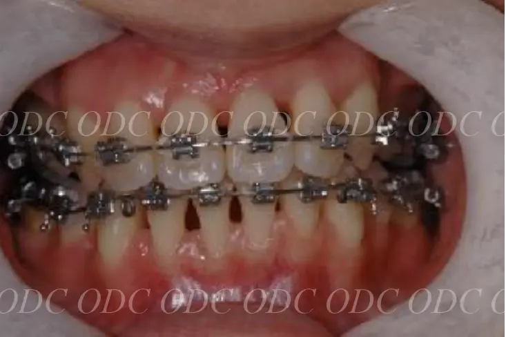 噛み合わせのズレ