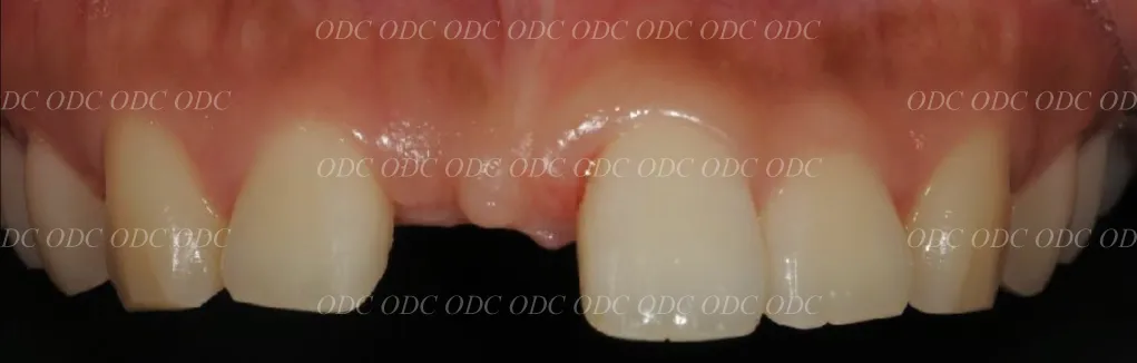 前歯部　少数歯欠損症例