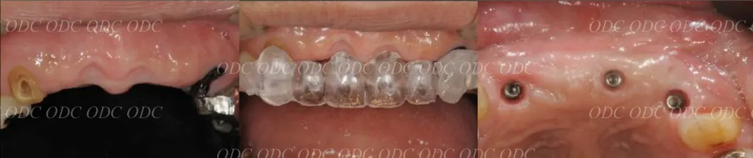 前歯部　多数歯欠損症例