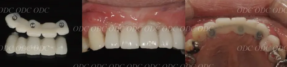 前歯部　多数歯欠損症例