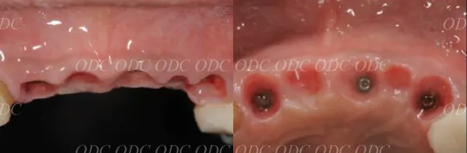 前歯部　多数歯欠損症例