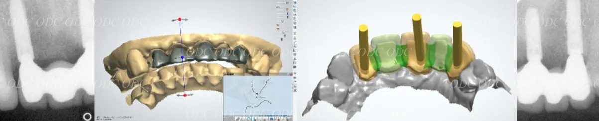 前歯部　多数歯欠損症例