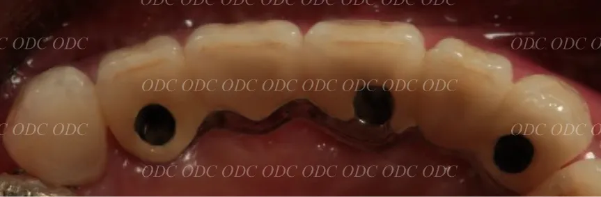 前歯部　多数歯欠損症例