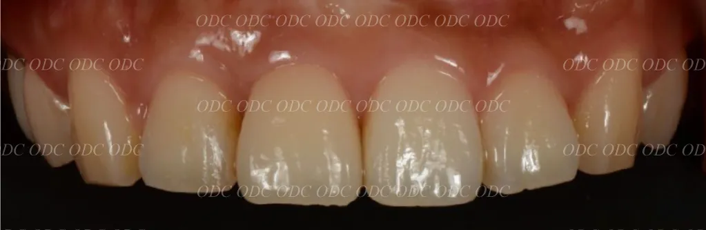 前歯部　少数歯欠損症例