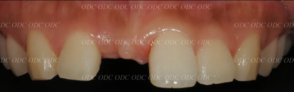 前歯部　少数歯欠損症例