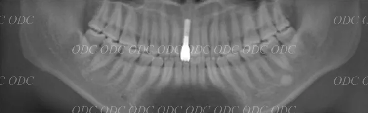 前歯部　少数歯欠損症例