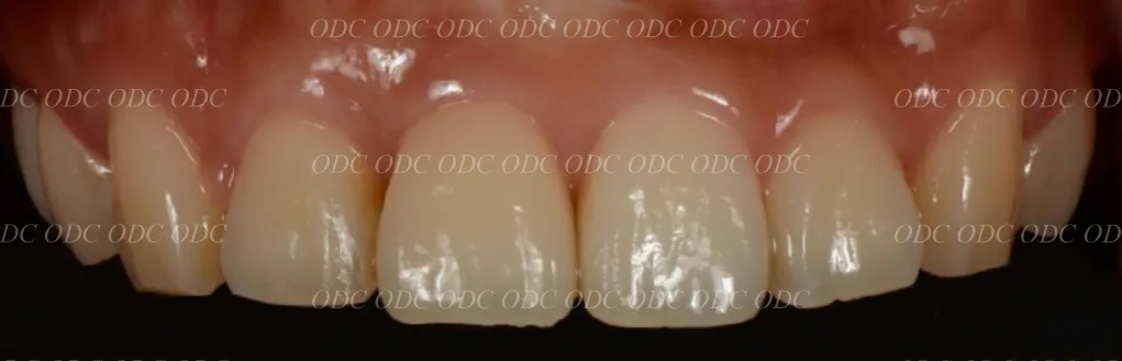 前歯部　少数歯欠損症例
