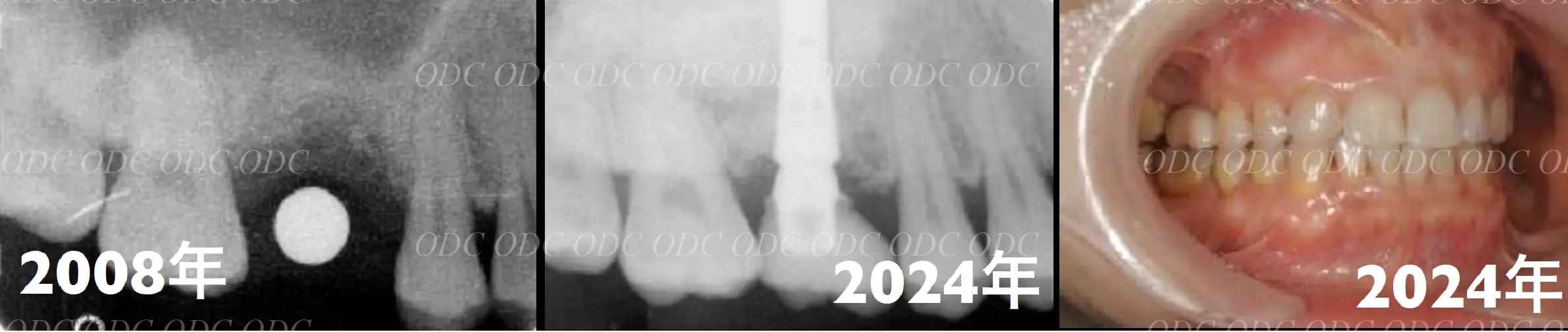 サイナスリフト