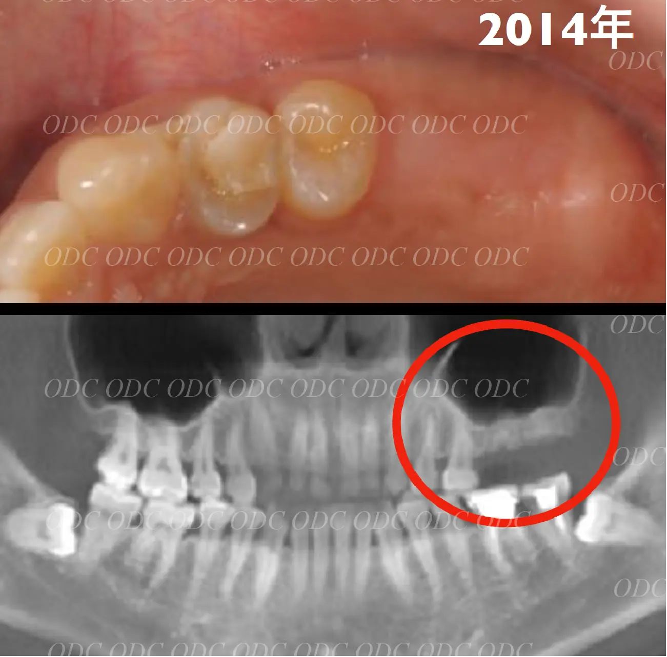 サイナスリフト