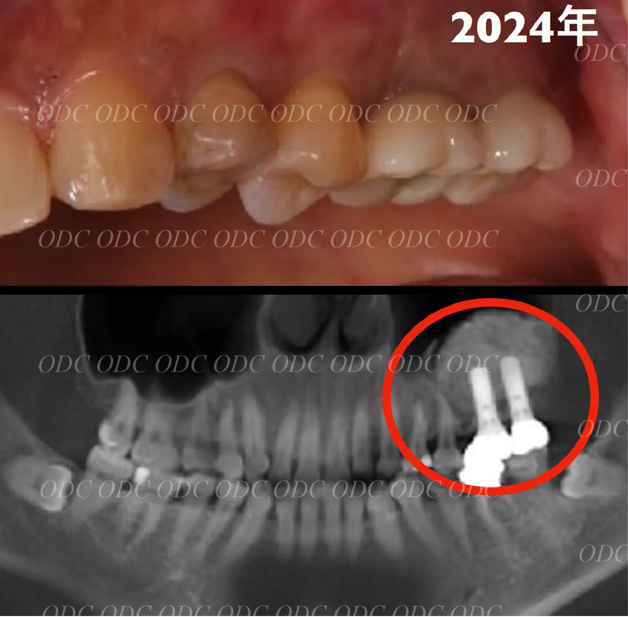 サイナスリフト