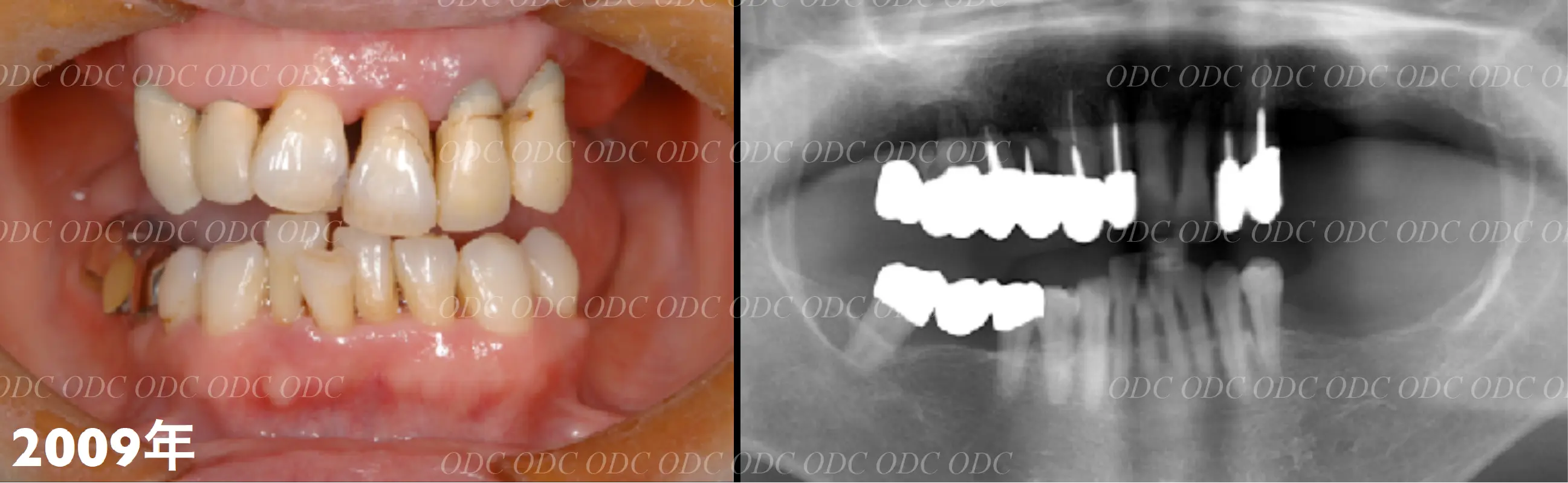 サイナスリフト